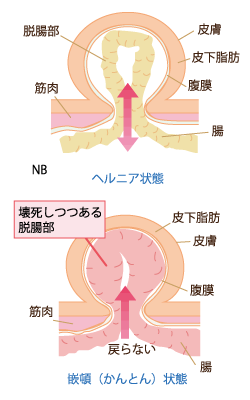 ヘルニア状態と嵌頓状態